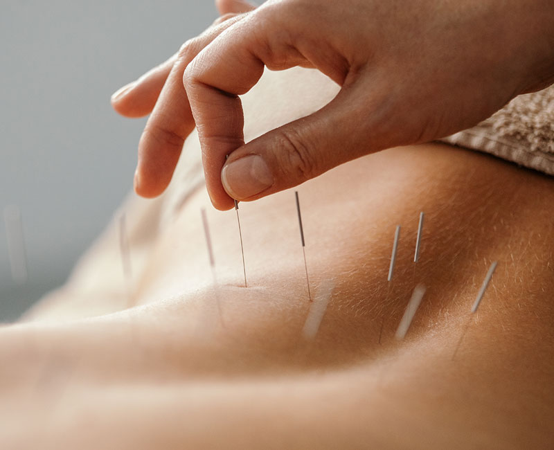 Acupuncture An Ancient Healing Practice