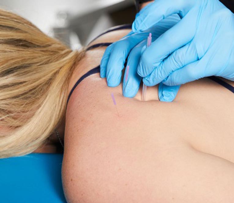 Dry Needling in Cancer Support